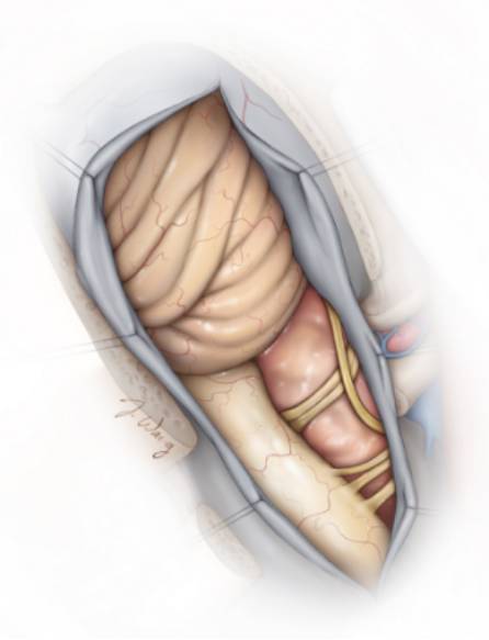 枕骨大孔区脑膜瘤的手术策略与技巧 the neurosurgical atlas全文