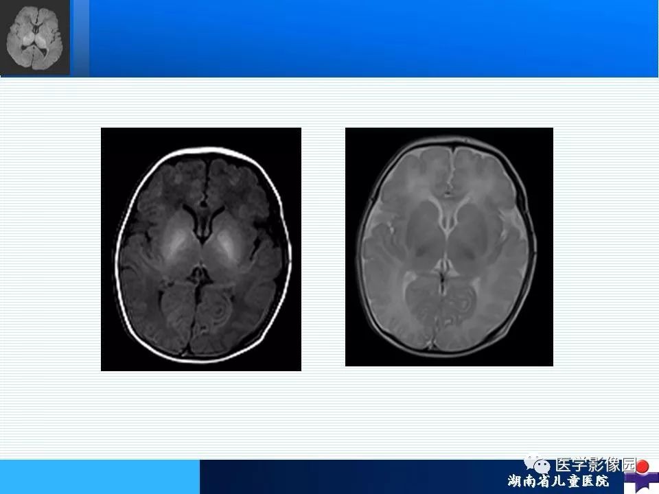 新生儿脑损伤的影像学诊断丨影像天地