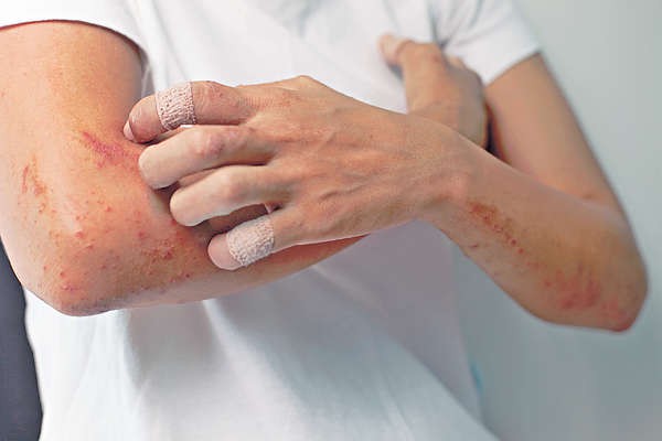 防治湿疹不反复:最佳治疗的3个方法,老中医力推