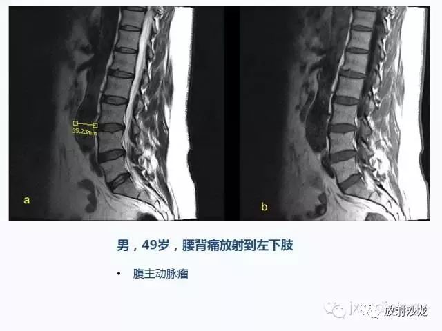 腰椎ct,mri检查的脊柱外异常发现:图片综述