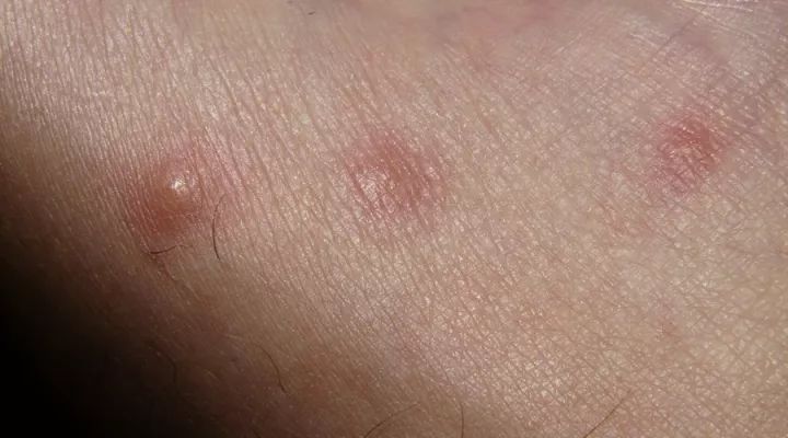 出疹期初期为 粉红色小丘疹,经1-2天变成椭圆形,绿豆大小的水疱,水疱