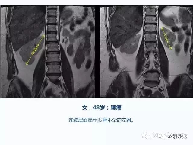 腰椎ct,mri检查的脊柱外异常发现:图片综述