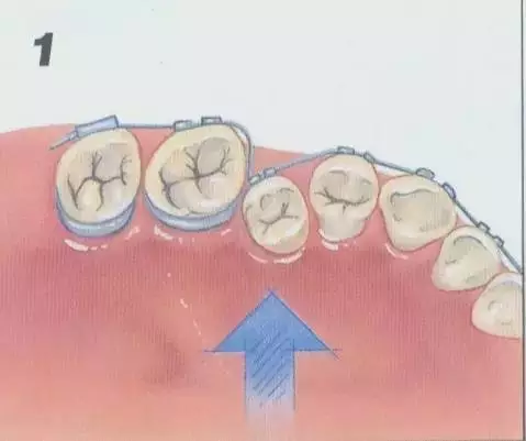 正畸矫正牙齿的基本原理图示