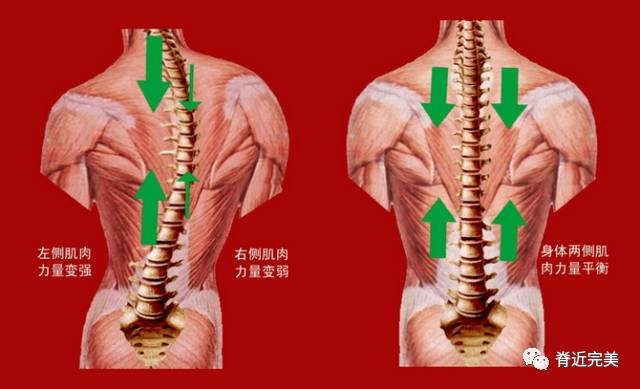 肌肉失衡分析得出脊柱侧弯并非无药可救