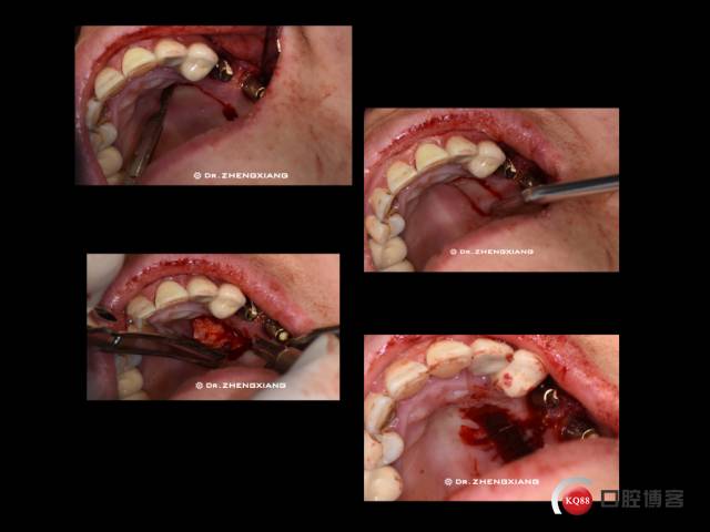 种植牙从无到有 从骨到肉 最后软组织处理的必要性