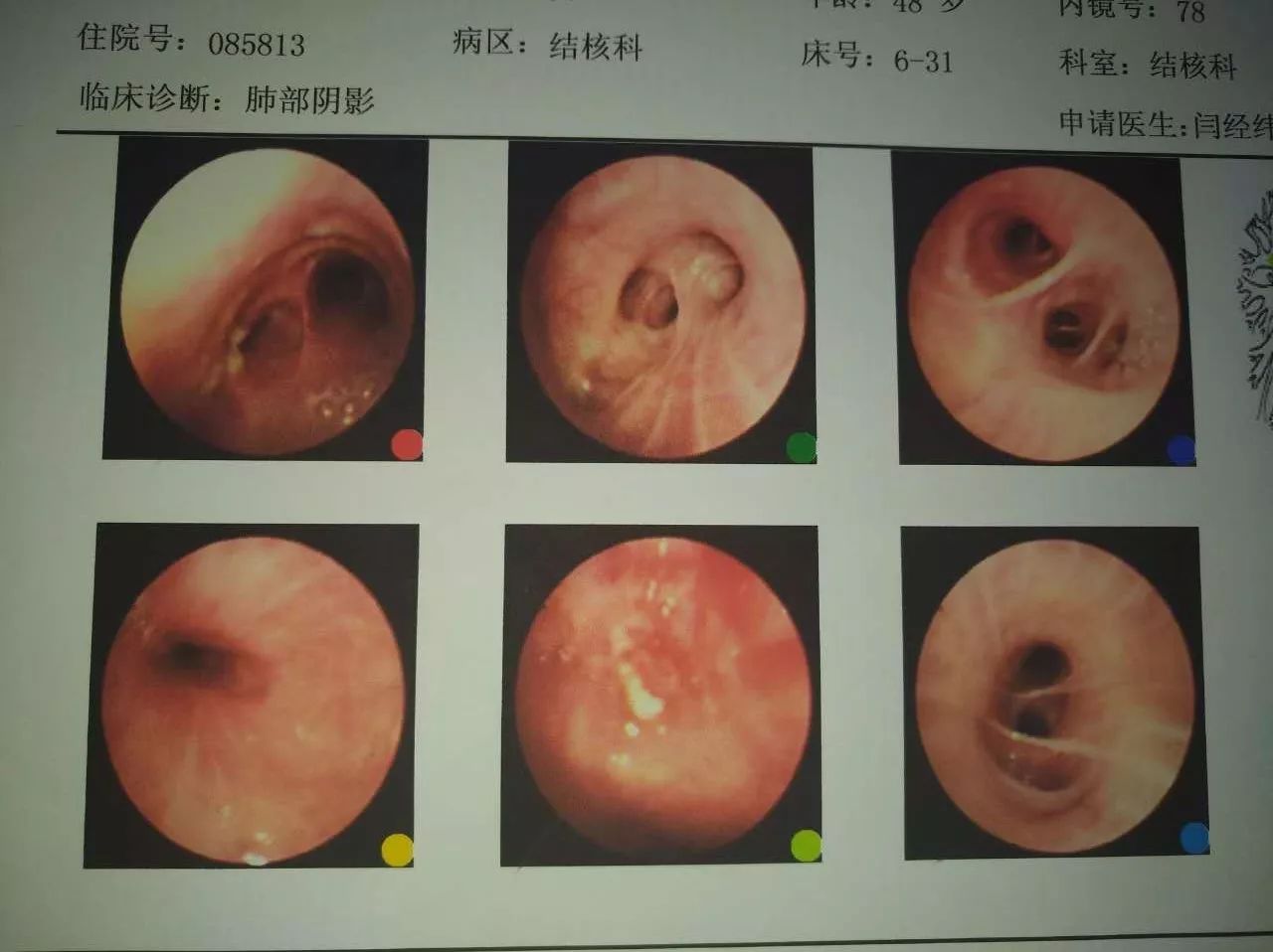 经我院结核科会诊,决定为其进行电子气管镜检查,以明确诊断.