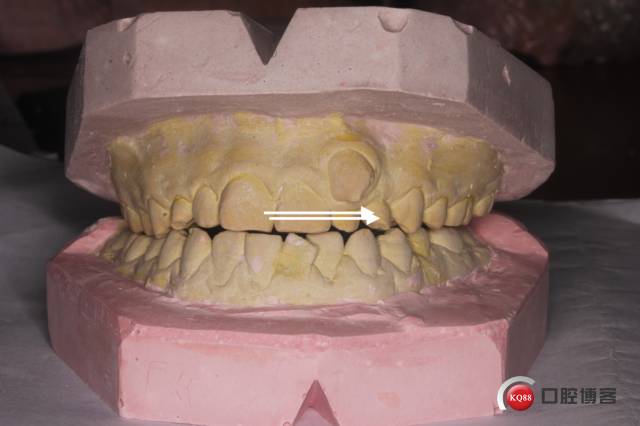 辅助弓矫治一例尖牙错位