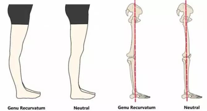 掌握这几招,告别弓型腿!