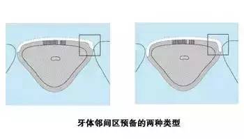 牙体龈端的预备