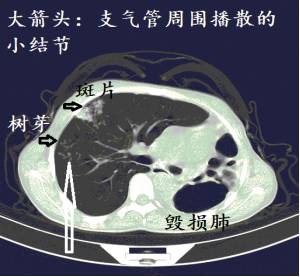 【实战演练】十二个病人的肺ct图像详细解读!