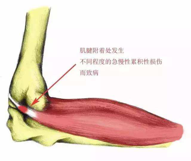 中医推拿培训—网球肘的预防与治疗