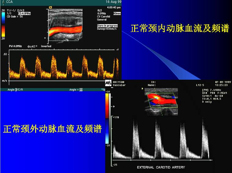 颈动脉超声检查及诊断标准