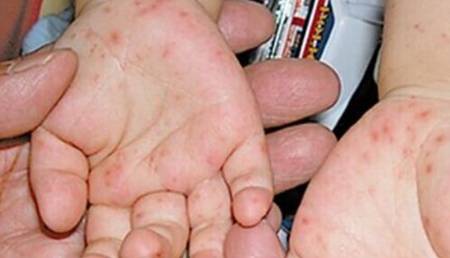 其实,除了手足口病之外,生活中常有的水痘,疱疹性咽峡炎,丘疹性麻疹