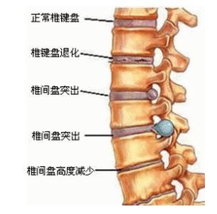 朴槿惠告诉你关于腰椎间盘突出症的三件事