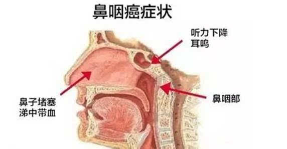 《士兵突击》演员刁海明因鼻咽癌去世,鼻咽癌的五种症状别忽视!