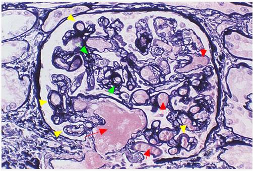 (参考ahus and c3 glomerulopathy:2015 ki 小叶间动脉慢性期,可见