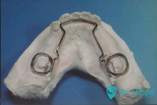 钢丝与带环或全冠连接,沿着空隙的两侧延伸到另一颗牙齿上,这样就能起