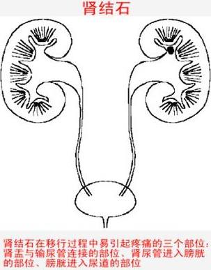 北京华科医院_肾结石的危害