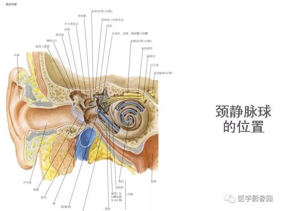 颈静脉球瘤影像表现丨影像天地