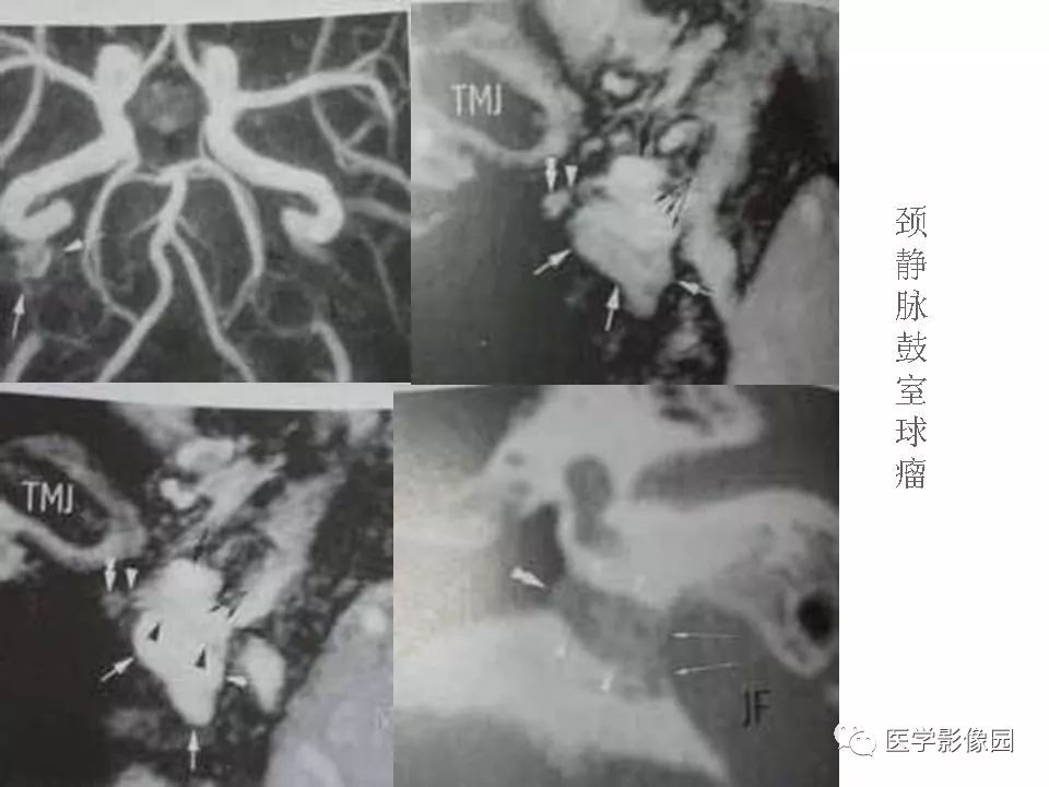 颈静脉球瘤影像表现丨影像天地