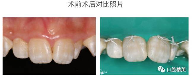 前牙美学树脂充填病例分享