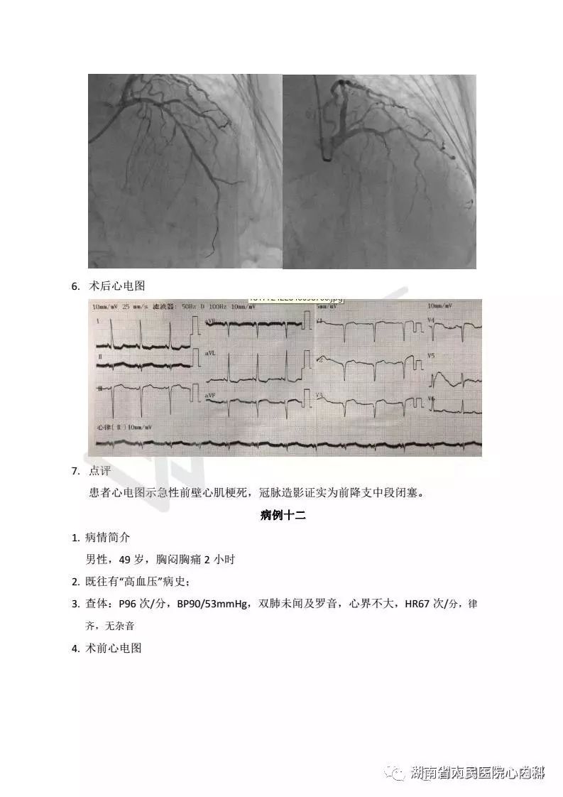 湖南省人民医院胸痛中心急性心梗病例2017年11月第二周