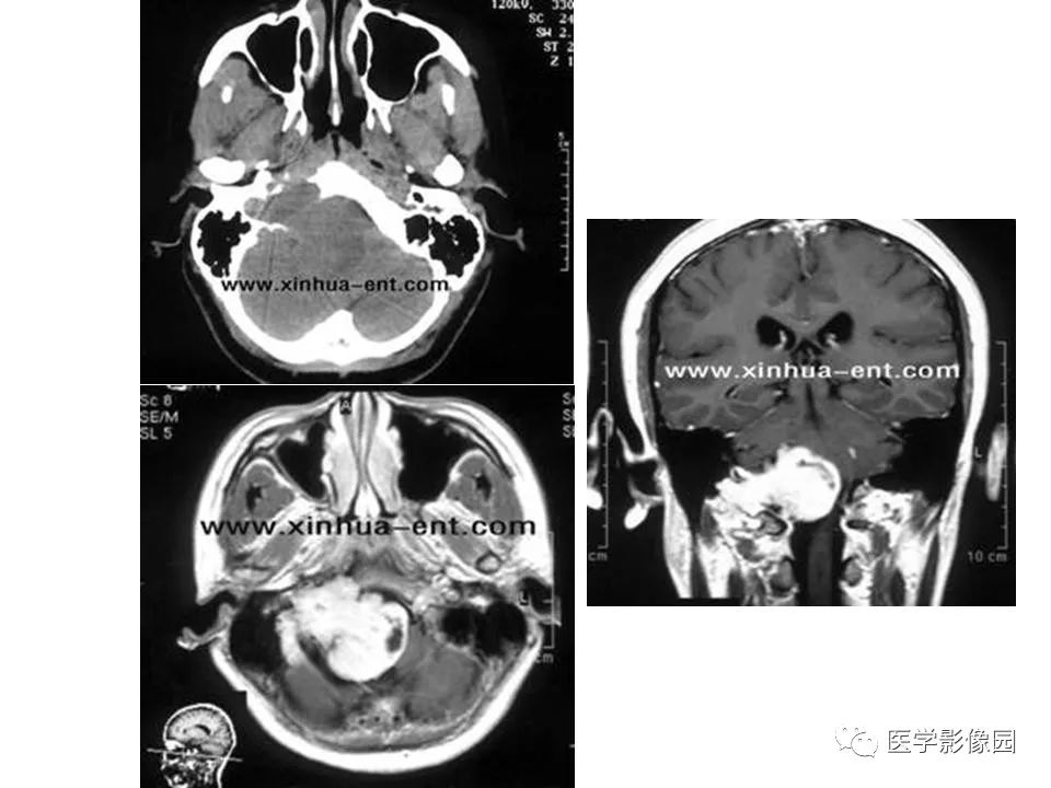 颈静脉球瘤影像表现丨影像天地