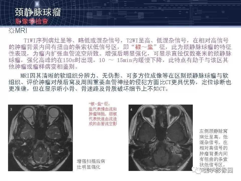 颈静脉球瘤影像表现丨影像天地