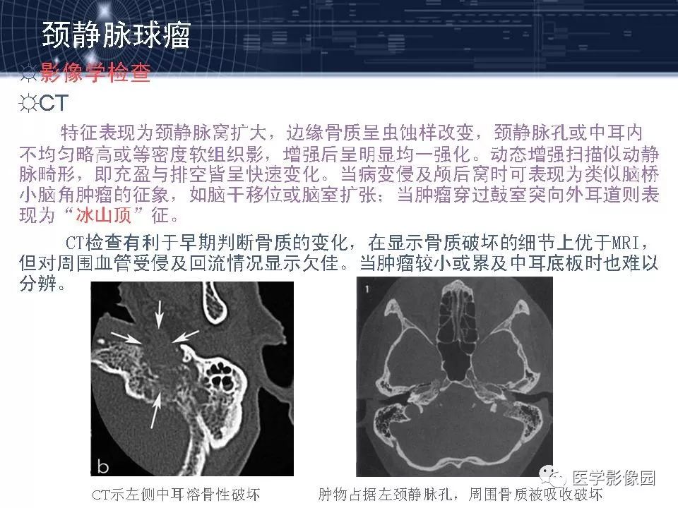 颈静脉球瘤影像表现丨影像天地