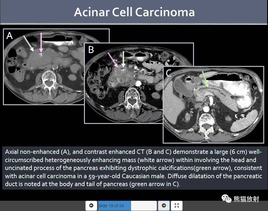 腺泡细胞癌:59岁男性,胰头肿物,边界清楚,不均质强化,内见钙化,胰腺体