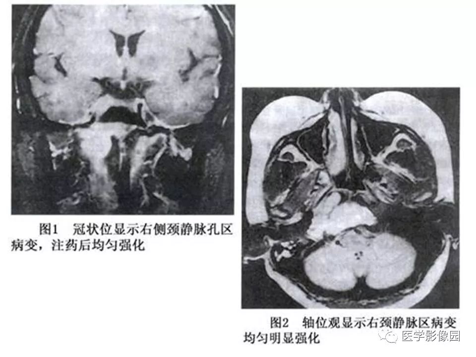 颈静脉球瘤影像表现丨影像天地