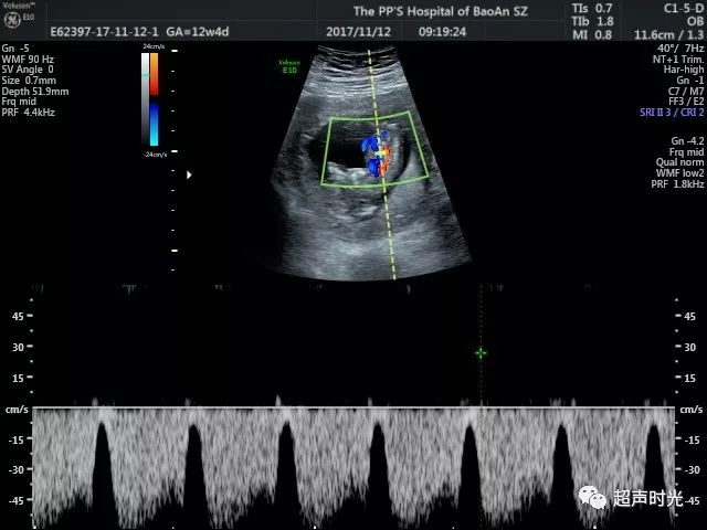 可显示清晰胎儿静脉导管频谱形态未见明显异常.
