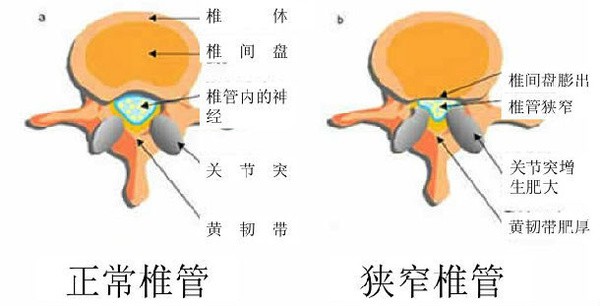 3.其他原因所致的椎管狭窄,1)腰椎滑脱,该平面椎管矢状径减小.