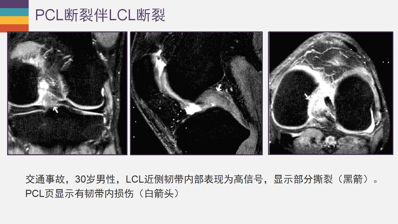 膝关节外侧副韧带及外侧支持带解剖及损伤mr诊断