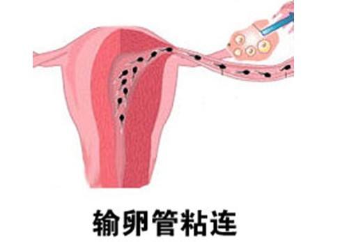 盆腔积液和输卵管黏连对试管婴儿移植会有影响吗?_搜狐母婴_搜狐网