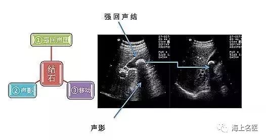 长征医院专家提醒预防胆结石从合理安排饮食开始切勿养石为患