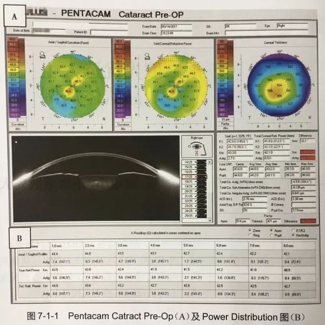 pentacam结果解读