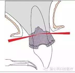 图3 水平切口:沟内切口图2 内斜切口的不同水平:嵴顶原位复位瓣的切口