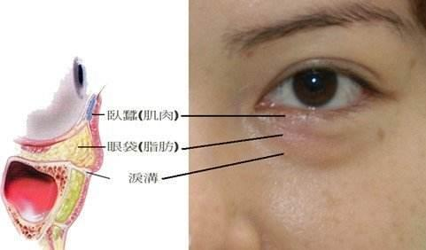 眼袋,就是下眼睑浮肿,由于眼睑皮肤很薄,皮下组织薄而松弛,很容易