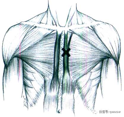 激痛点疗法胸骨肌