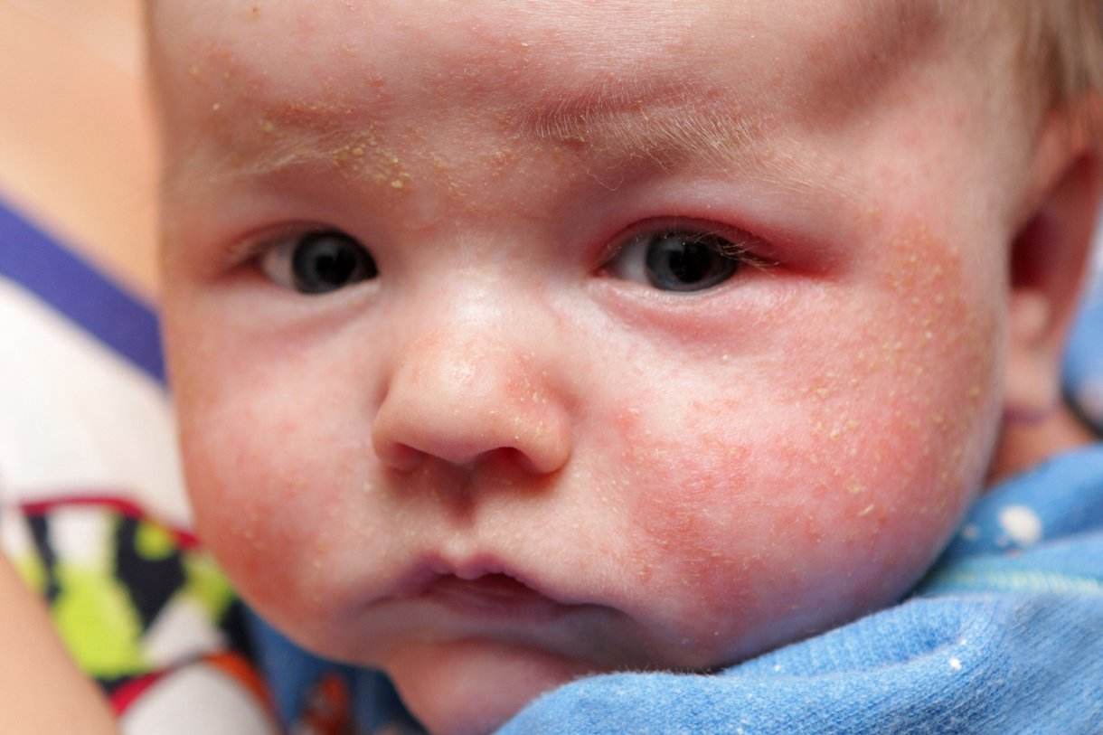 宝宝身上的疹子到底是啥？婴儿痤疮、脂溢性皮炎和湿疹有啥区别？