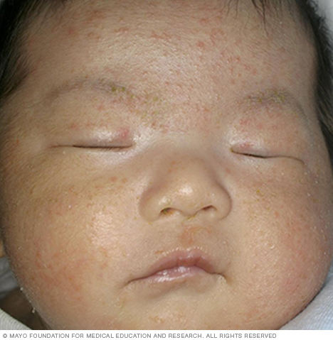 宝宝身上的疹子到底是啥？婴儿痤疮、脂溢性皮炎和湿疹有啥区别？