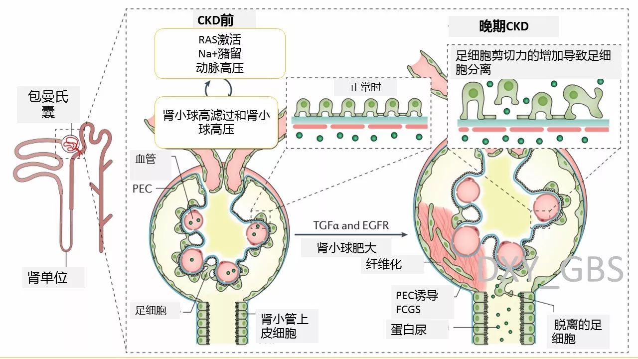 力的增加,将引起足细胞(一种维持肾小球滤过屏障的重要细胞)的分离,局