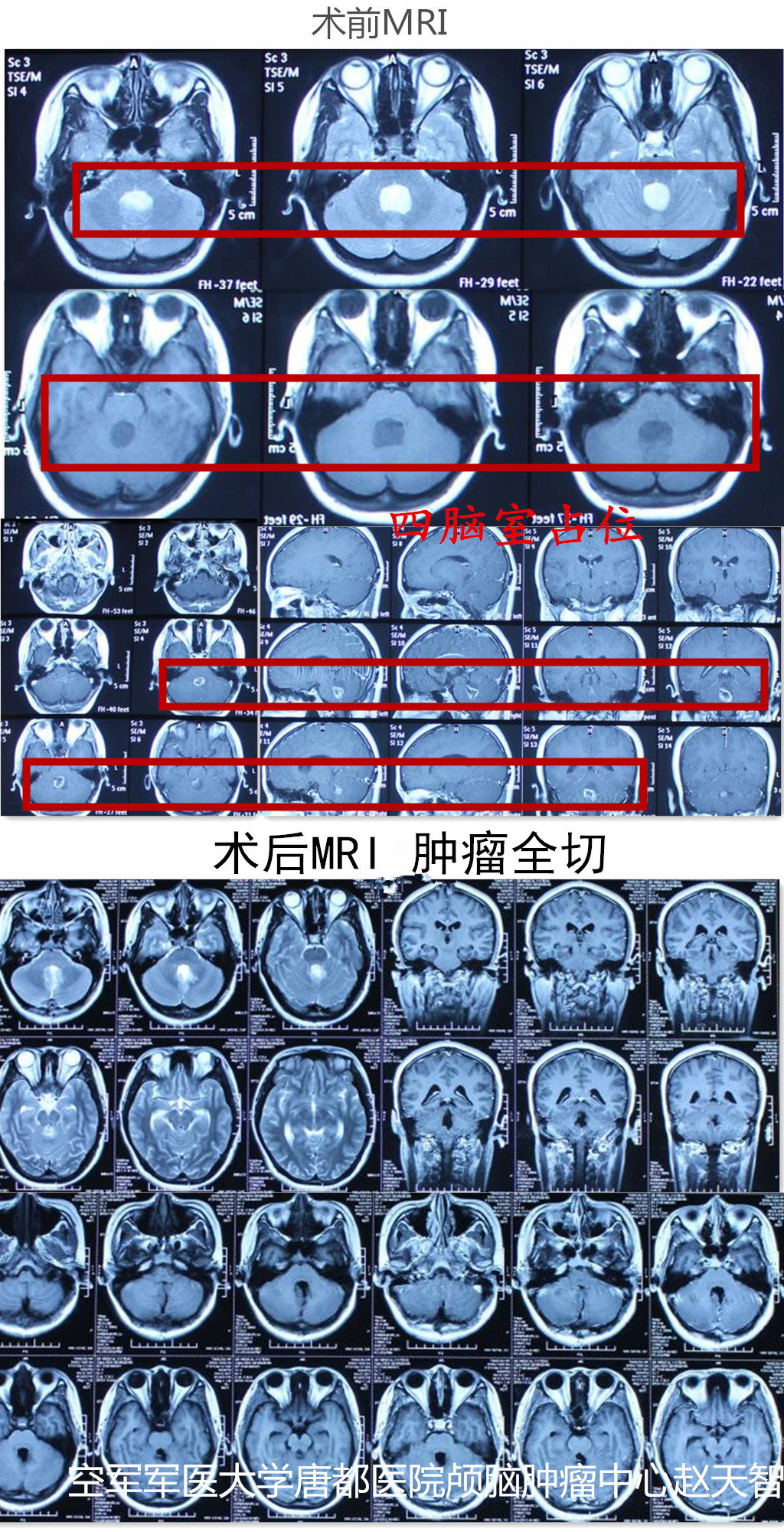 【典型病例-四脑室占位】唐都颅脑肿瘤专家赵天智,"精湛医术"除"胶质