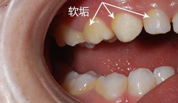 让孩子远离小黑牙,你需要定期给ta清洁小牙呦