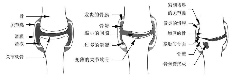 科学说:膝盖,为什么受伤的老是你