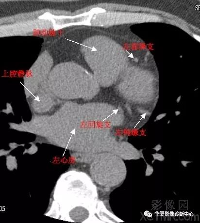 心脏冠状动脉ct解剖中文详细标注图文