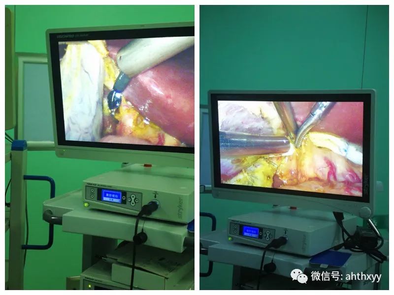 县医院成功开展腹腔镜联合胆道镜胆总管切开取石术