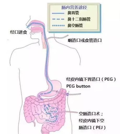 牙齿在咀嚼中发挥关键作用,牙齿的数量,质量与患者生活质量,营养状况