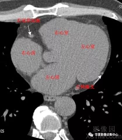 心脏冠状动脉ct解剖中文详细标注(图文)